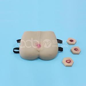 Stage of pressure ulcers nursing model