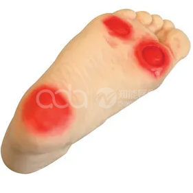 модель язвы стопы диабетика