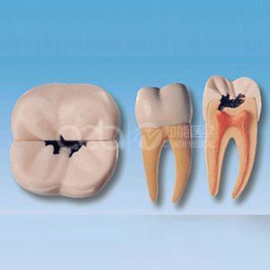 Справа от первой модели кариеса моляра