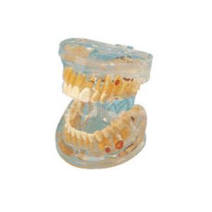 Патологическая прозрачная модель зуба