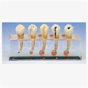 Клиническая модель заболевания пульпы зубов